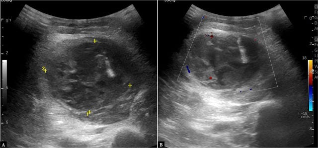 Hematoma ecografia tempo formacion 5.jpg